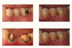 Porcelain Fixed Dentures