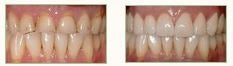 Bel Air Dental Caps