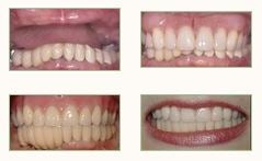 Full Dentures