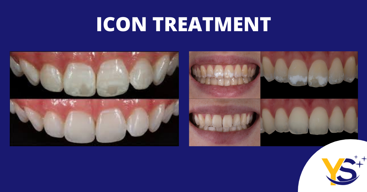 ICON, "White Spot" Treatment Your Smile Dentistry