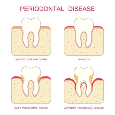 Gum Disease in Bel Air 