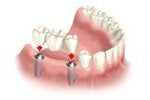 Dental Bridges in Bel Air