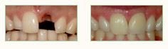 Dental Implants Bel Air