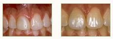 Dental Crowns