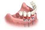 Dental Bridge Attachment