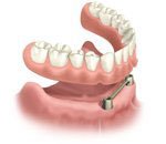 Removable Implant Anchored Overdenture