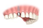 Dental Implant Installation