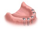 Bel Air Dental Implant Installation