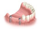 Dental Implant Installation in Bel Air