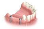 Dental Implant Installation in Bel Air