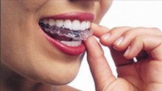 Invisalign Product