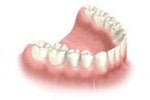 New Dental Bridge Installed