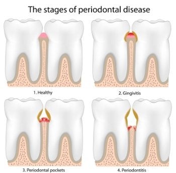 Periodontal Disease Process
