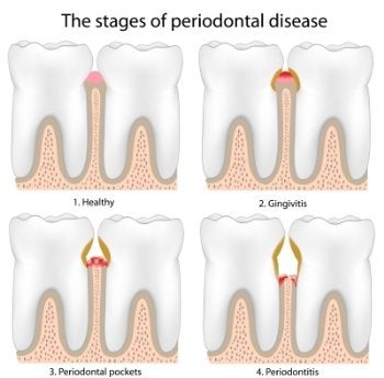 Periodontal Disease Process