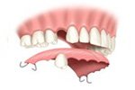 Removable Partial Dental