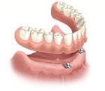 Removable Overdenture