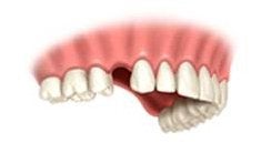 Single Missing Tooth