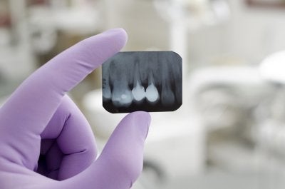 Teeth X-Rays